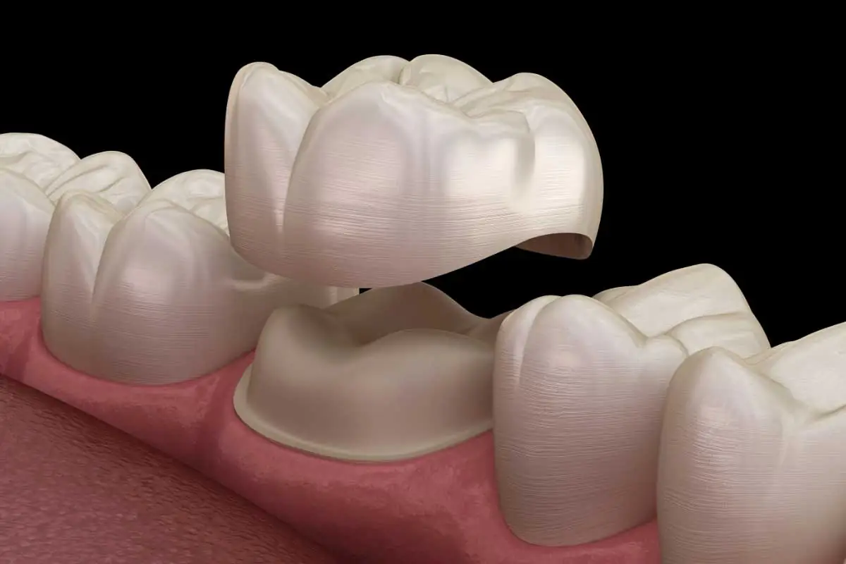 digital image showing how a dental crown is placed