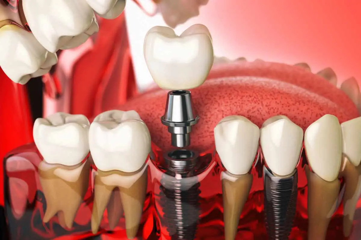 digital diagram showing how a dental implant is placed